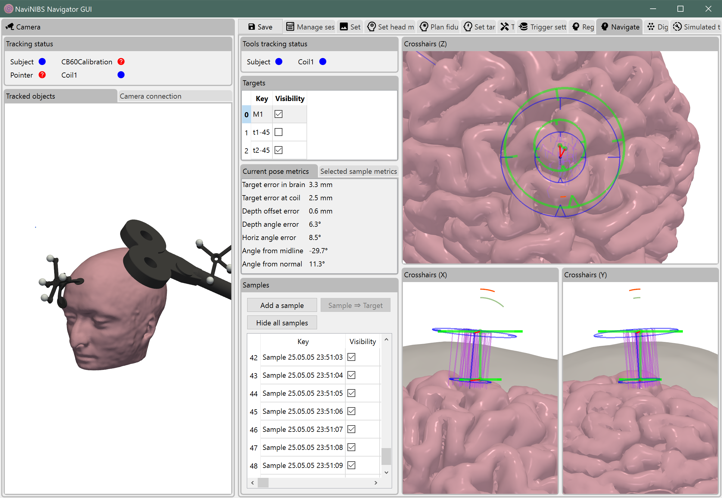 Example of neuronavigation
