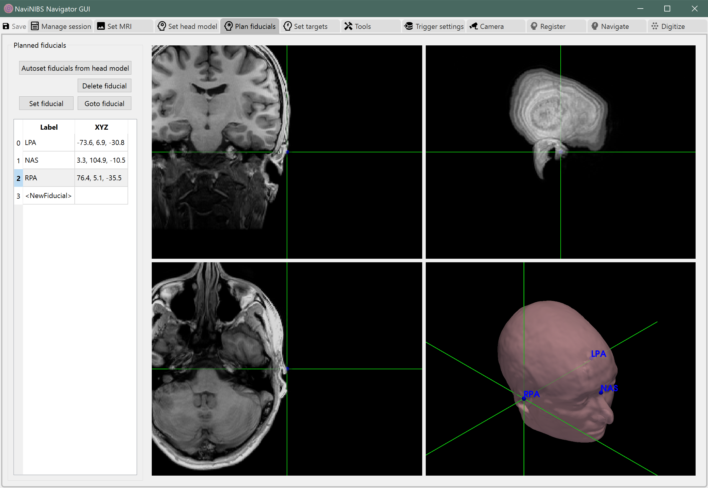 ../_images/PlanFiducials_Autoset.png